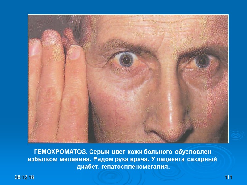 08:12:02 111 ГЕМОХРОМАТОЗ. Серый цвет кожи больного обусловлен  избытком меланина. Рядом рука врача.